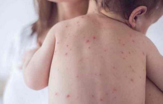 Ξεπέρασαν τα 2.000 τα κρούσματα ιλαράς