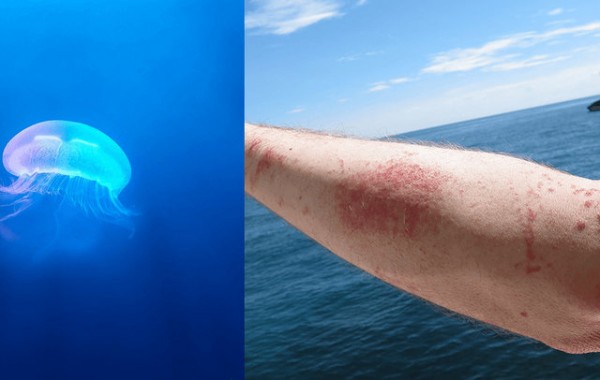 Τι πρέπει να κάνετε αν σας τσιμπήσει τσούχτρα