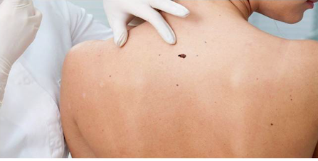 ΣΤΥΡΑ: Δωρεάν εξέταση για μελανώματα