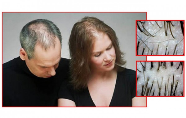 Τρία καθημερινά λάθη που προκαλούν τριχόπτωση