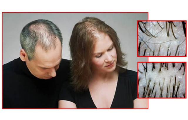 Τρία καθημερινά λάθη που προκαλούν τριχόπτωση