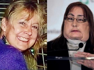 Ολική μεταμόσχευση προσώπου