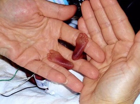 Το πιο πρόωρο μωρό του κόσμου επέζησε!