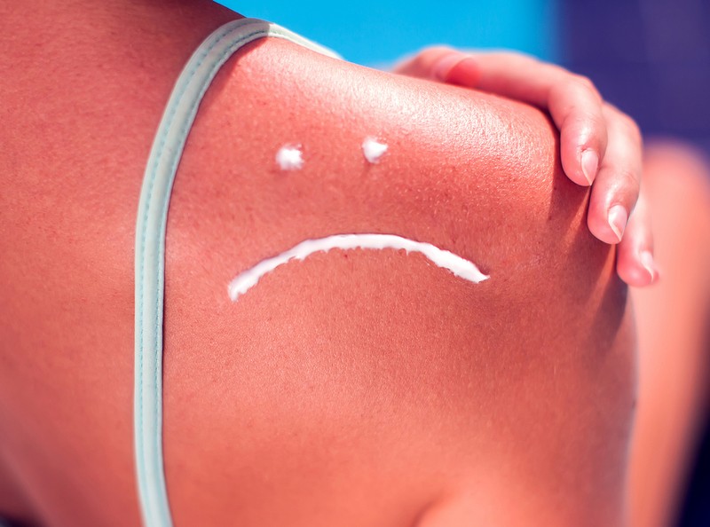 DIY: Αυτή η μάσκα θα σε βοηθήσει να αντιμετωπίσεις το έγκαυμα