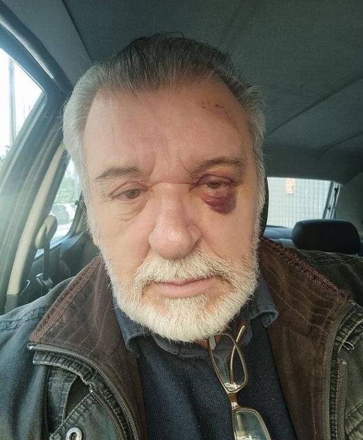 Ο Τάσος Χαλκιάς ...ποζάρει με τουμπανιασμένο μάτι