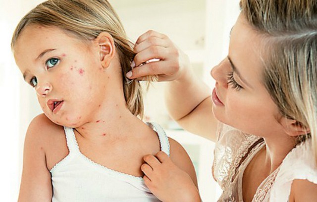 Αυτές οι τροφές είναι υπεύθυνες για τις παιδικές αλλεργίες