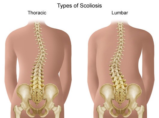 Δωρεάν εξετάσεις κύφωσης και σκολίωσης στη Χαλκίδα