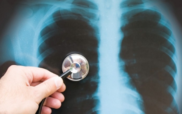 Γιατροί και δικηγόροι μιλάνε για τη φυματίωση