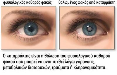 Αυτά είναι τα σημάδια του καταρράκτη στα μάτια