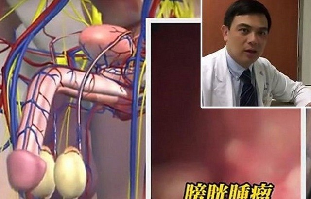 Είχε στύση μία ολόκληρη εβδομάδα και τελικά του έκοψαν το πέος